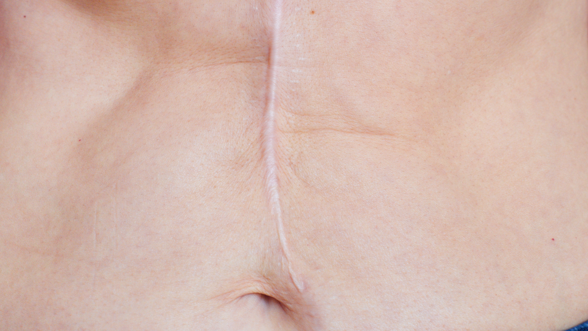 A person with a surgery scar above their naval